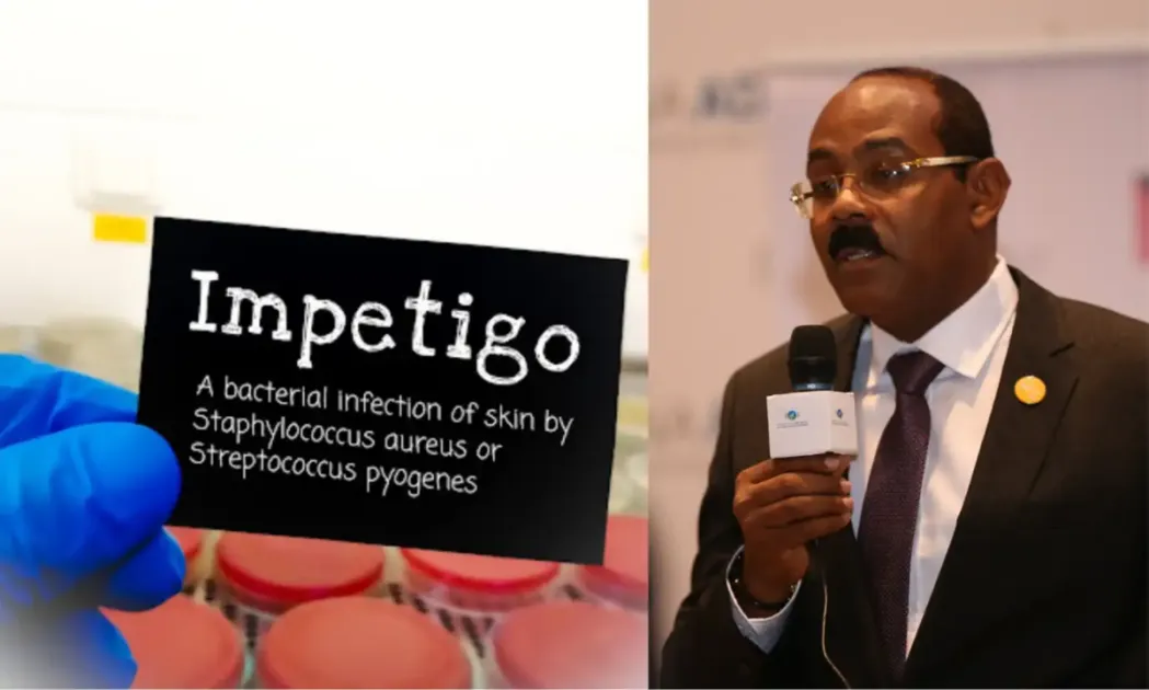 Antigua and Barbuda strengthens efforts to combat Impetigo outbreak ...